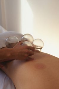 Woman lying face down having cupping acupuncture, mid section