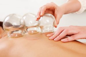 Cupping Therapy Naperville
